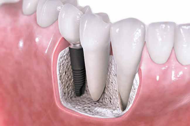 dantu-implantai