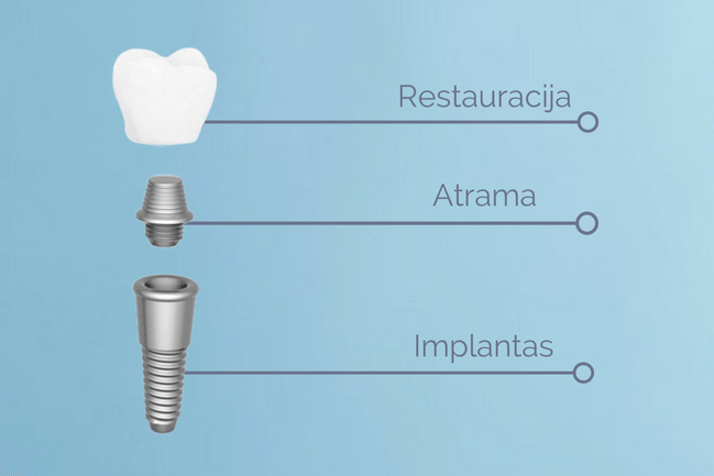 kas-yra-dantu-implantai
